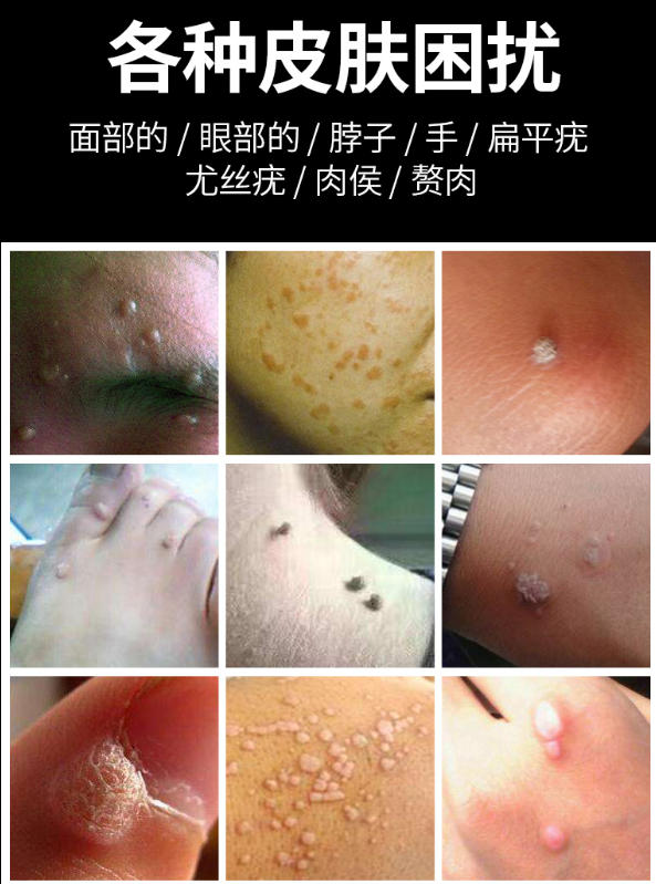 点痣祛斑培训