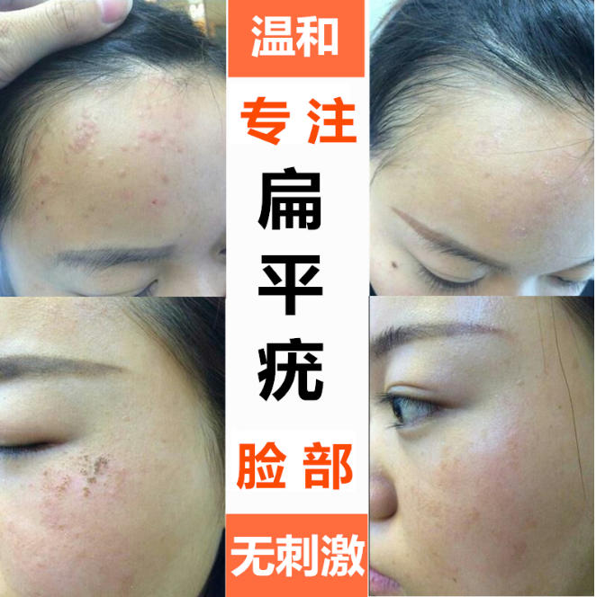 点痣祛疣祛斑培训机构哪家好top5名单汇总